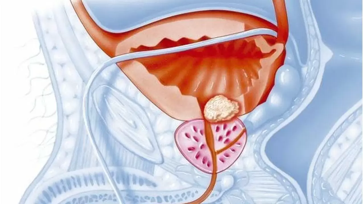 male prostate disease